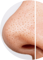 Open pores