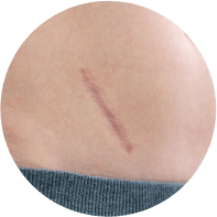 Scars