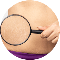 Stretchmarks
